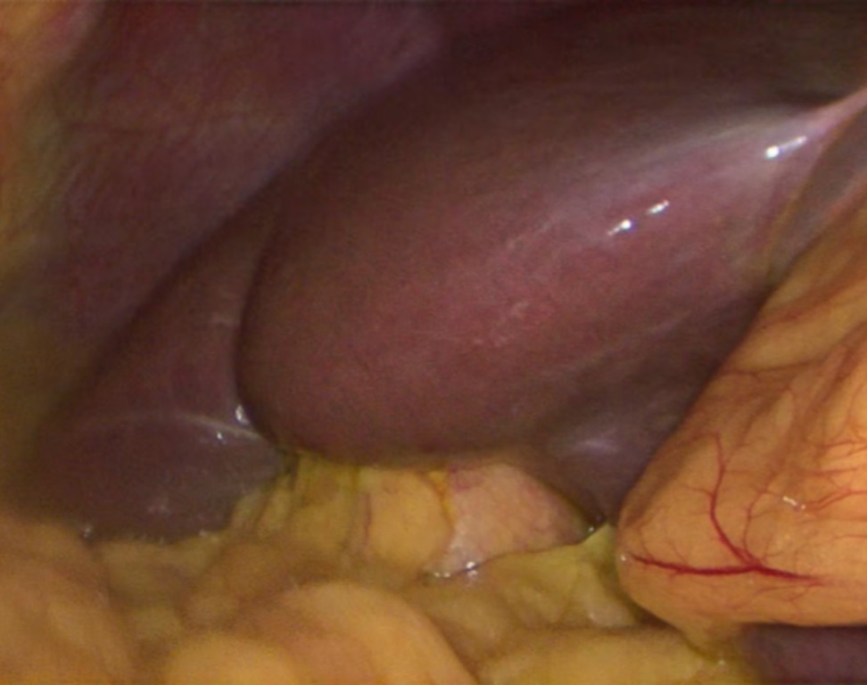 El signo del fruncido detectado en el intraoperatorio